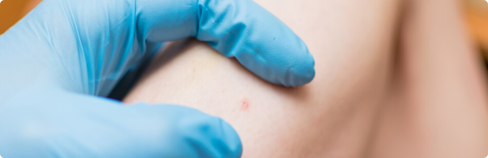 Hauttuberkulose - Wie diagnostiziert der Arzt eine Hauttuberkulose?