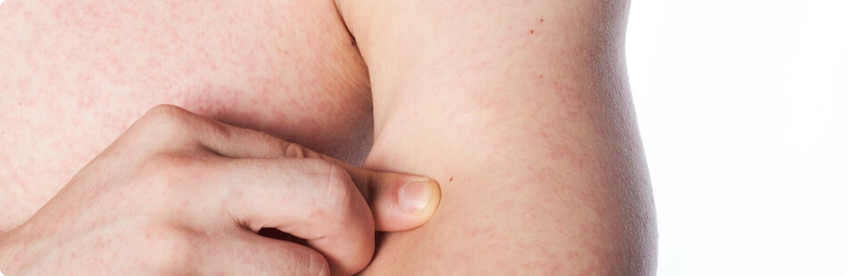 Hauttuberkulose - Wie verläuft die Behandlung?