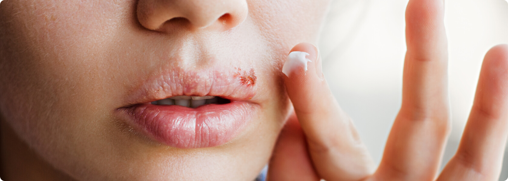 Herpes - Eine weitere Methode ist die Anzucht der Herpes-Viren