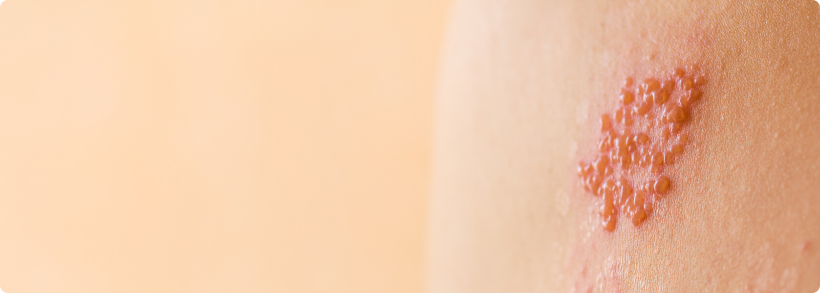 Herpes - Welche Sonderformen von Herpes gibt es?
