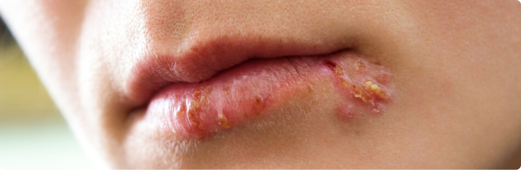 Herpes - Was ist Herpes?
