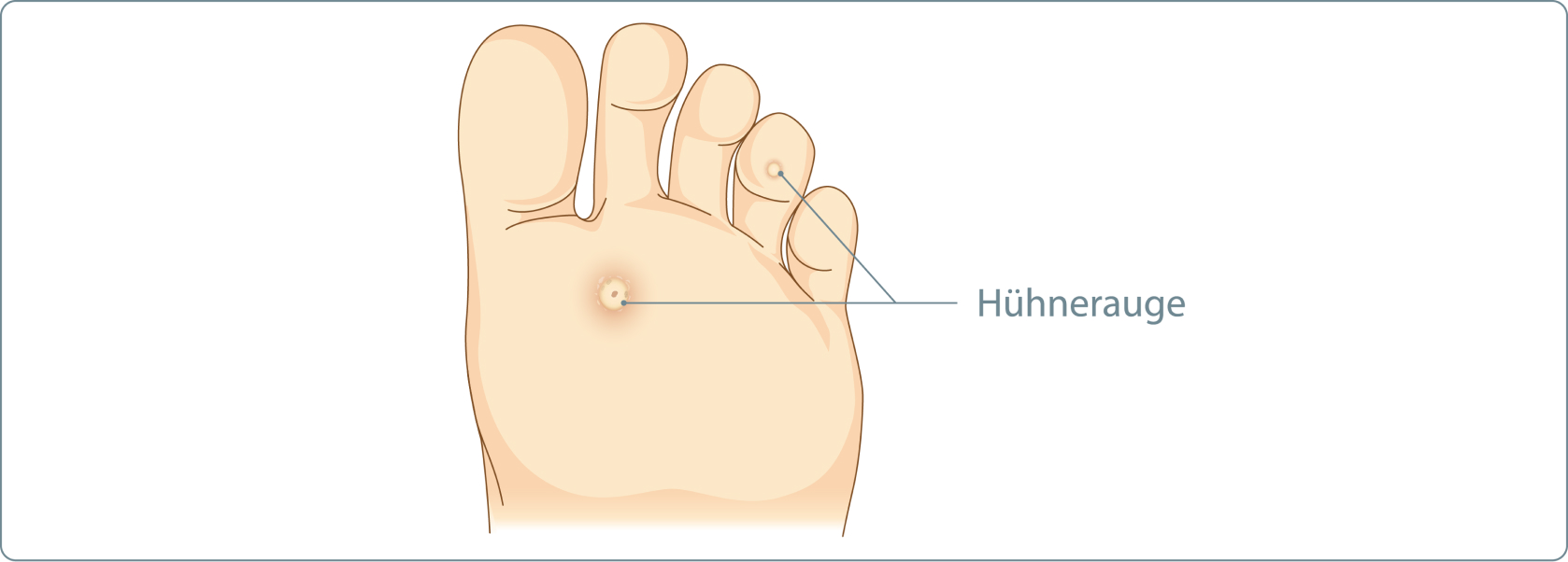 Hühnerauge - Welche Formen von Hühneraugen gibt es?