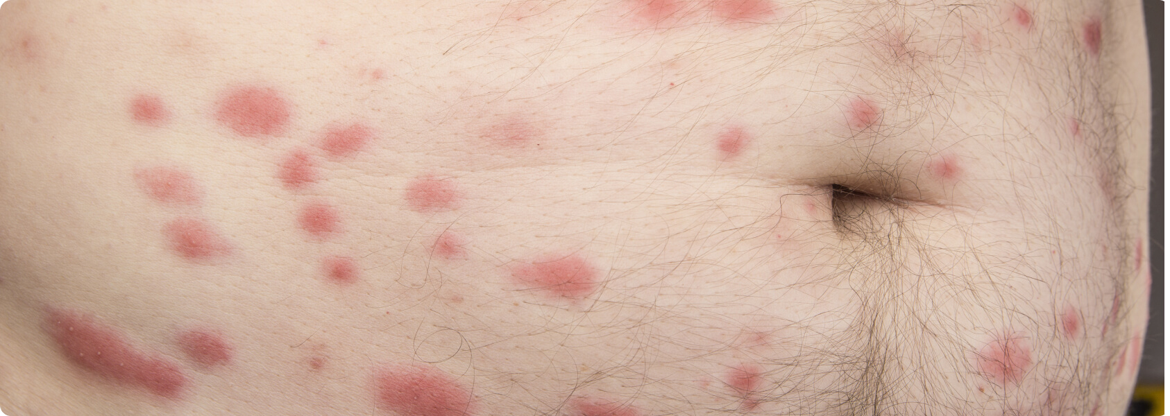 Kaposi-Sarkom - Was versteht die Medizin unter einem Kaposi-Sarkom?