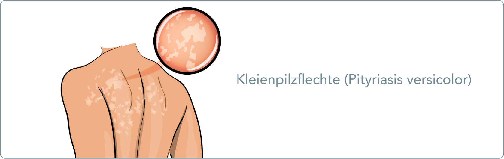 Kleienpilzflechte (Pityriasis versicolor) - Welche Ursachen hat eine Kleienpilzflechte?