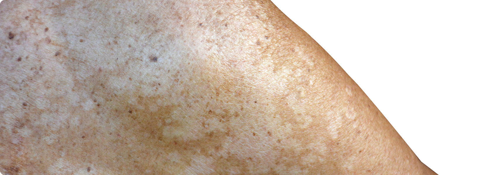Kleienpilzflechte (Pityriasis versicolor) - Was versteht die Medizin unter einer Kleienpilzflechte?