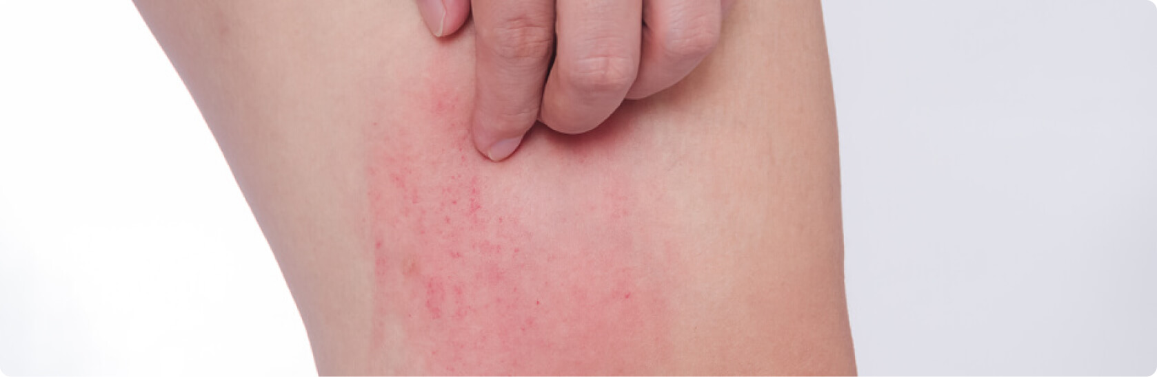 Kontaktallergie - Was versteht die Medizin unter einer Kontaktallergie?