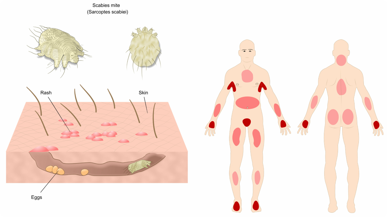 Krätze (Skabies/ Scabies) - Was ist unter Krätze zu verstehen?