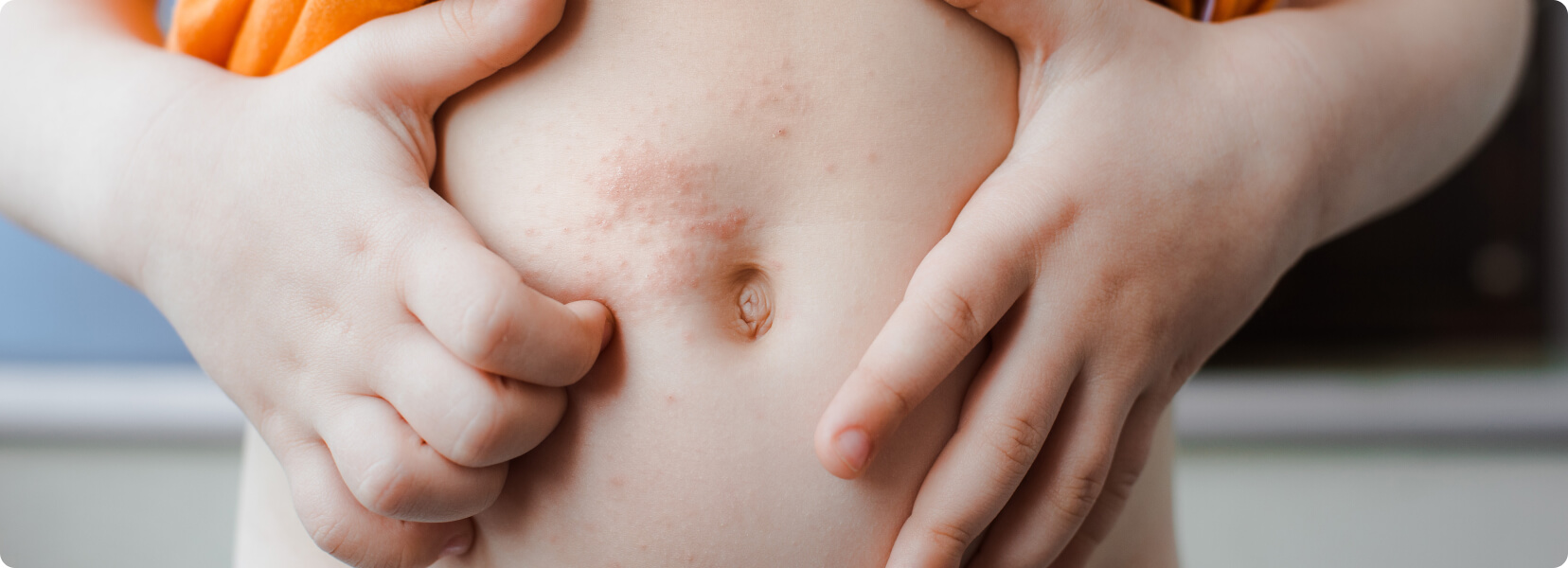 Krätze (Skabies/ Scabies) - Wie erfolgt die Diagnose bei Krätze?
