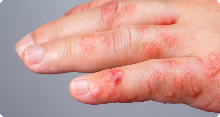 Krätze (Skabies/ Scabies) - Was ist die Scharlach-Angina?