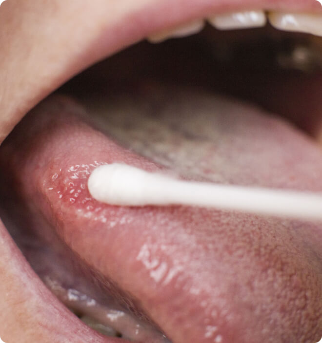 Leukoplakie - Wie wird eine Leukoplakie diagnostiziert?