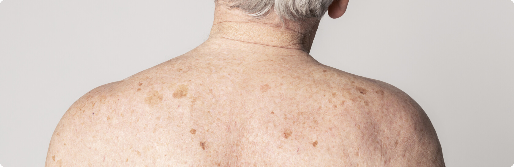 Morbus Bowen - Was versteht die Medizin unter Morbus Bowen?