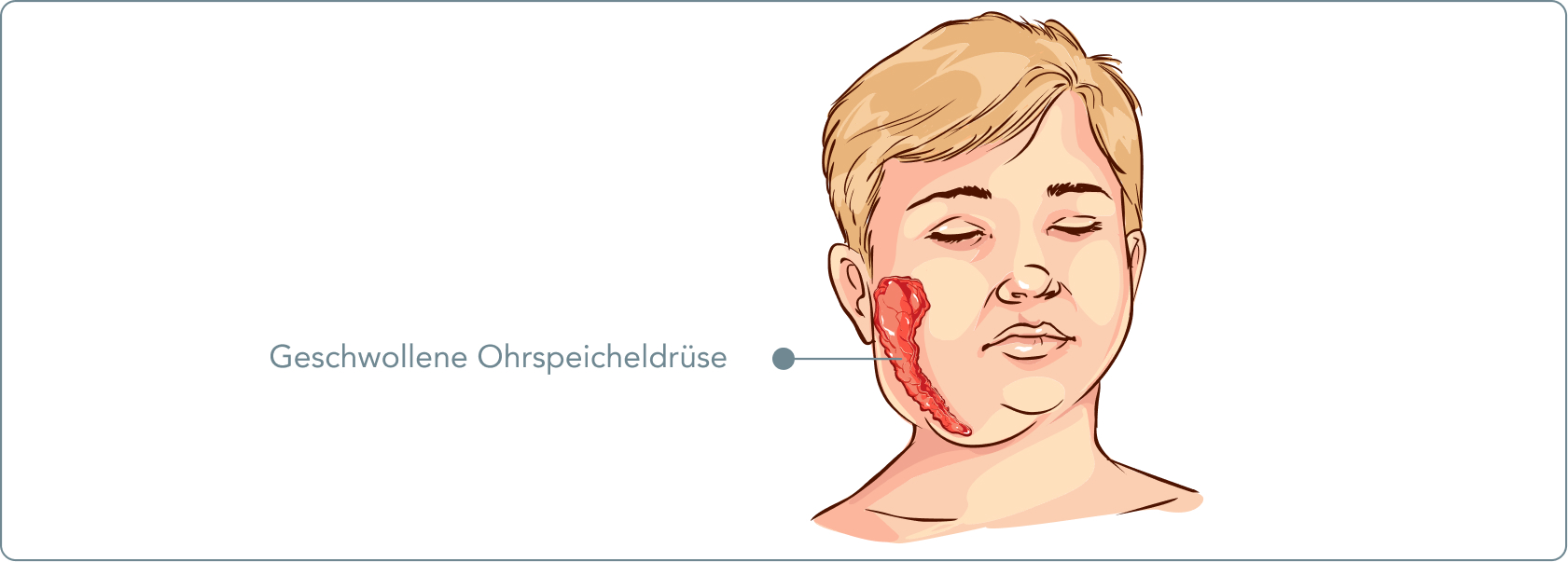 Mumps - Welche Organe befällt Mumps?