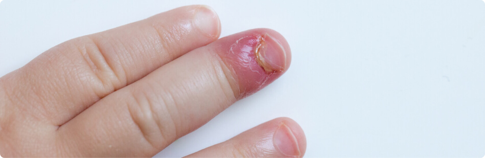 Nagelbettentzündung (Paronychie) - Was versteht die Medizin unter einer Nagelbettentzündung?