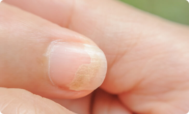 Nagelpilz - Welche Ursachen hat Nagelpilz?