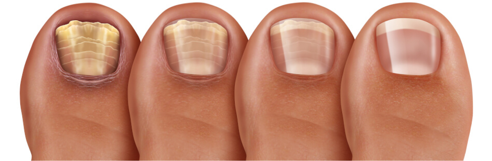 Nagelpilz - Wie macht sich eine distolaterale subunguale Onychomykose (DSO) bemerkbar?