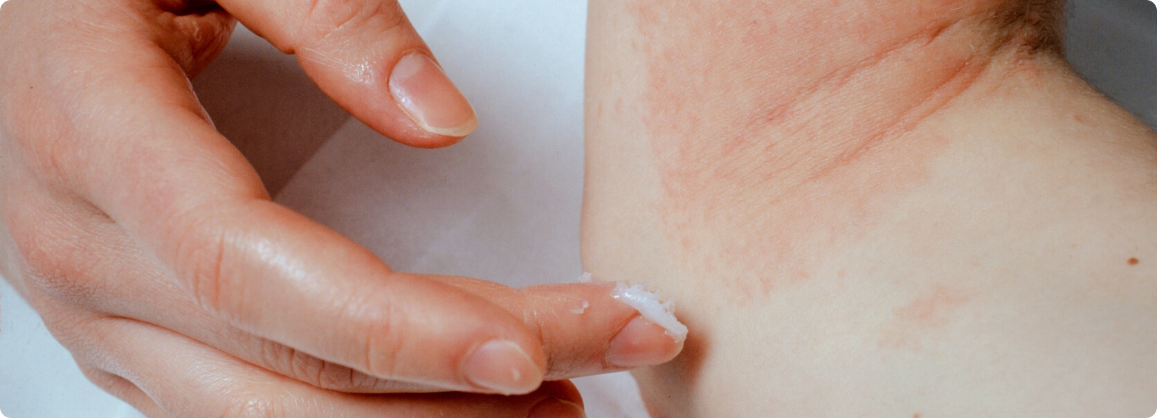 Neurodermitis (Atopische Dermatitis) - Welche negativen Folgen bringt das atopische Ekzem für die Betroffenen mit sich?
