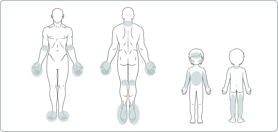 Neurodermitis (Atopische Dermatitis) - Welche Körperstellen sind besonders davon betroffen?