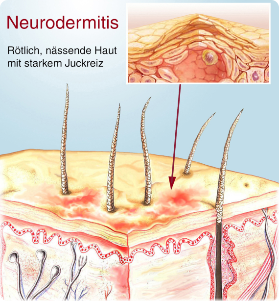 Neurodermitis (Atopische Dermatitis) - Wie sehen die Symptome der Erkrankung aus?