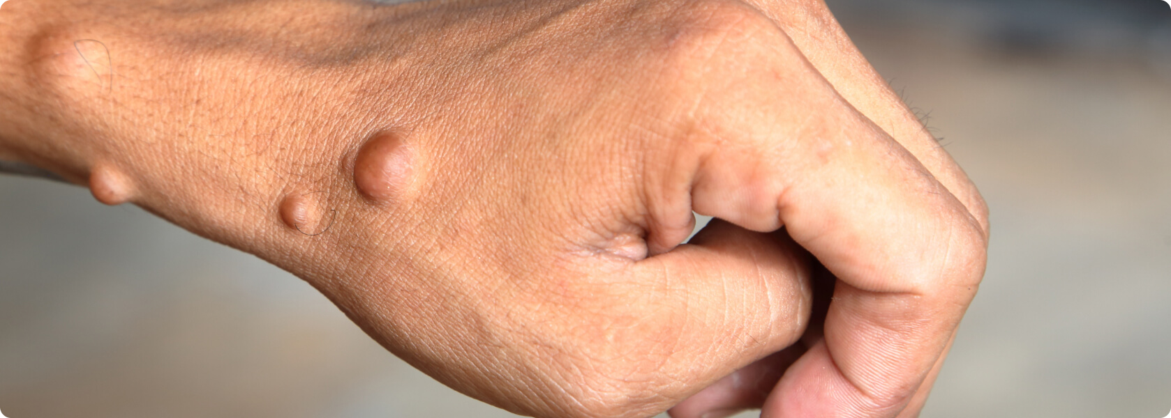 Neurofibromatose - Was versteht die Medizin unter einer Neurofibromatose?