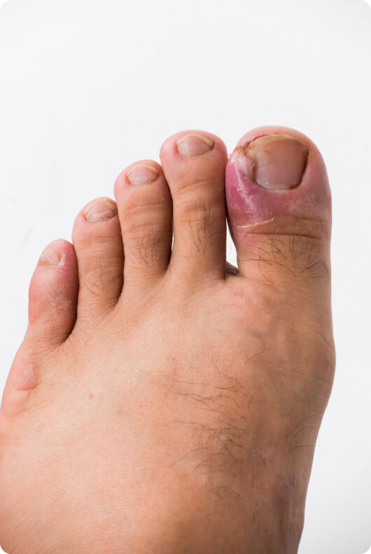 Panaritium - Wie lässt sich ein Panaritium behandeln?