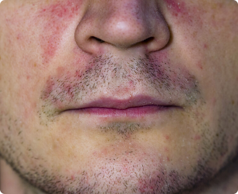 Periorale Dermatitis (Mundrose) - Welche Körperstellen sind bei einer Mundrose betroffen?