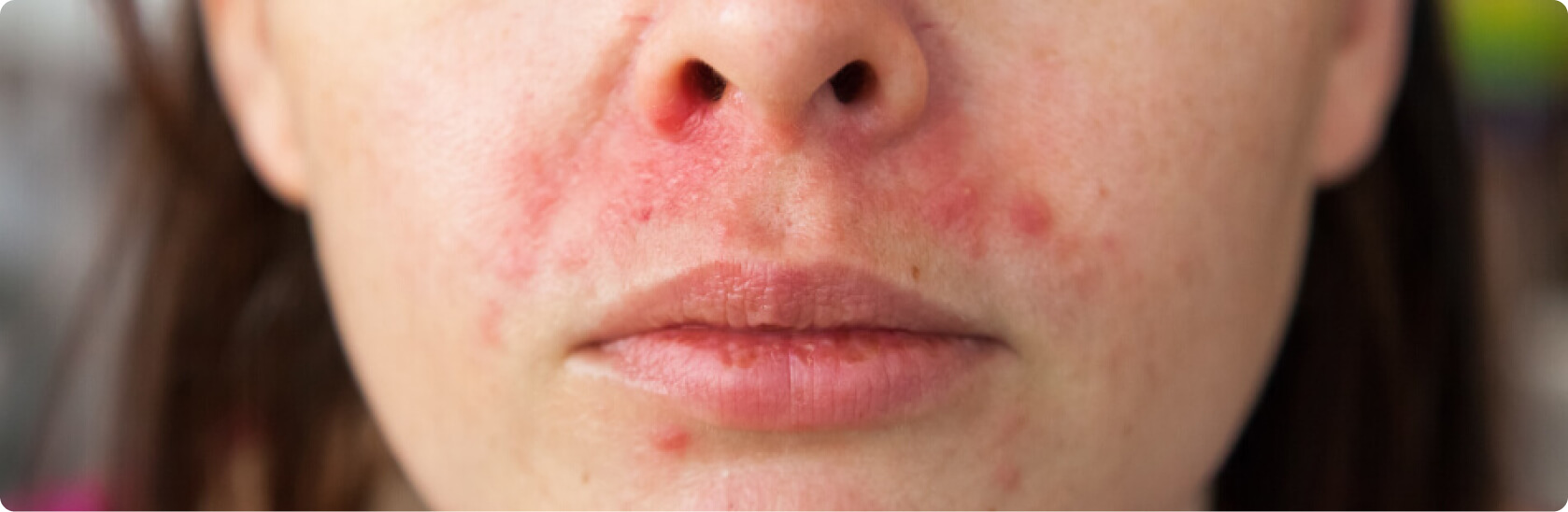 Periorale Dermatitis (Mundrose) - Was versteht die Medizin unter einer perioralen Dermatitis?