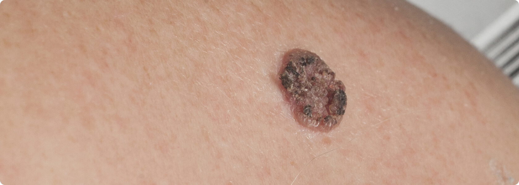 Plattenepithelkarzinom - Was versteht die Medizin unter einem Plattenepithelkarzinom?