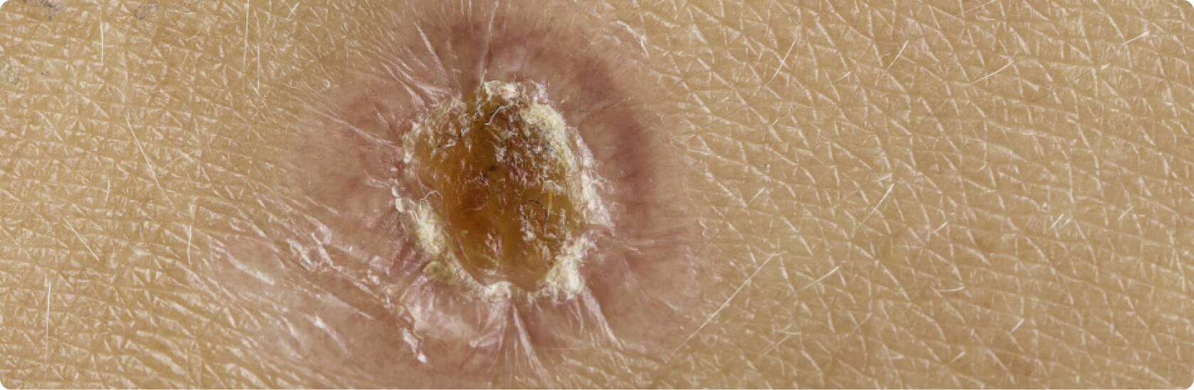 Prurigo nodularis - Was versteht die Medizin unter einer Prurigo nodularis?