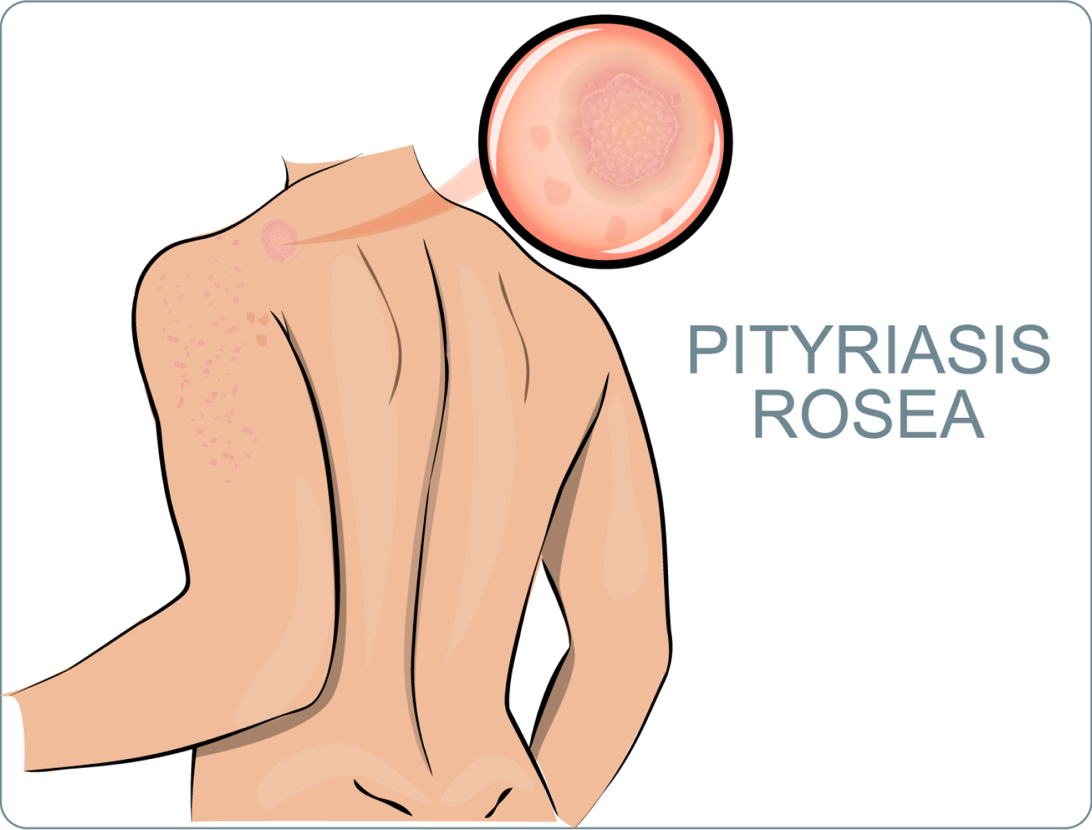 Röschenflechte (Pityriasis rosea) - durch das Auftreten ovaler Flecken auf der Haut
