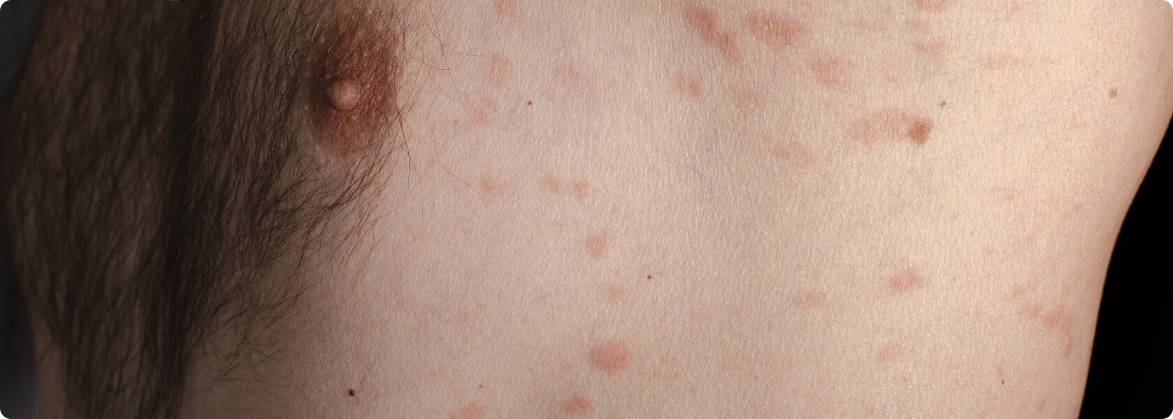 Röschenflechte (Pityriasis rosea) - Was versteht die Medizin unter einer Röschenflechte?