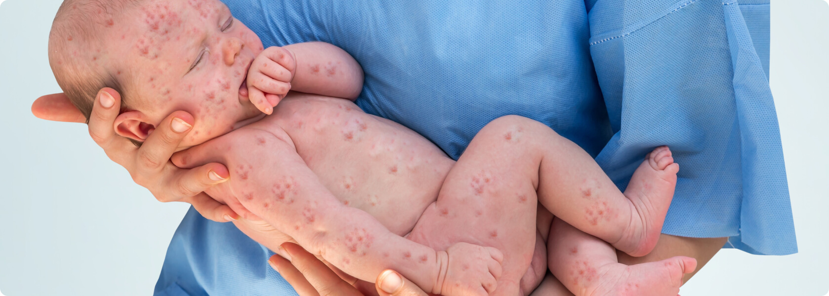 Röteln - Von welchen Krankheiten muss Rubella abgegrenzt werden?