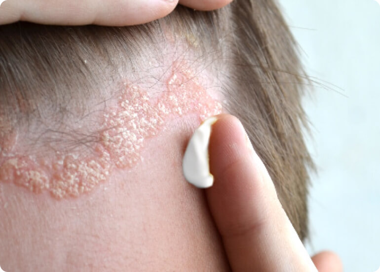 Schuppenflechte (Psoriasis) - Was kann ich selbst bei einer Schuppenflechte tun?
