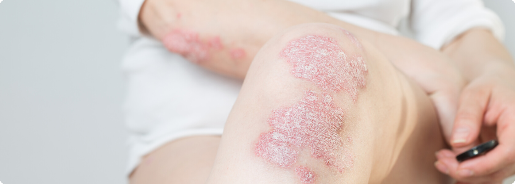 Schuppenflechte (Psoriasis) - Welche Formen der Psoriasis gibt es?