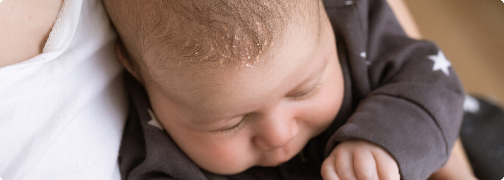 Seborrhoisches Ekzem - Wie äußert sich eine seborrhoische Dermatitis bei Säuglingen?
