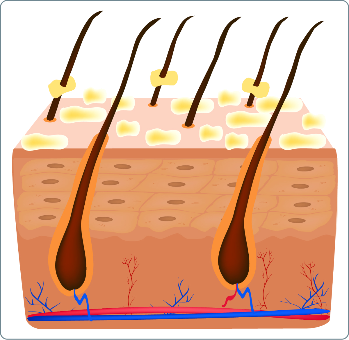 Seborrhoisches Ekzem - Welche Formen der seborrhoischen Dermatitis gibt es?