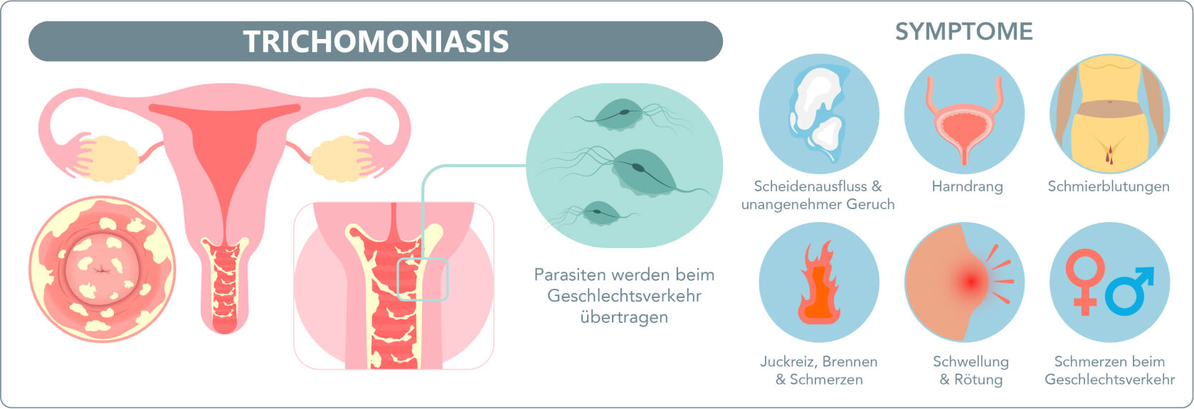 Trichomonaden (Trichomoniasis) - Zu den häufigsten Beschwerden zählen Symptome wie Scheidenausfluss