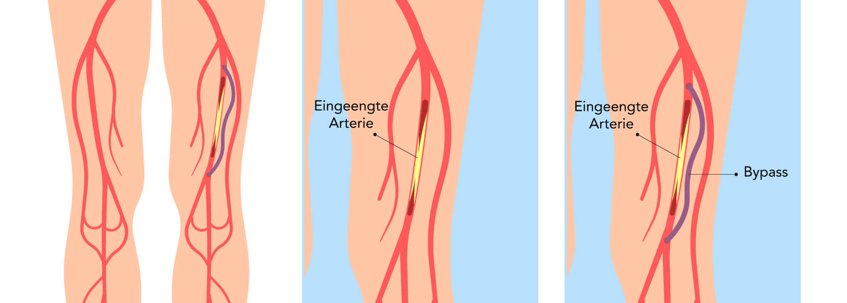 Ulcus cruris - Während der Angioplastie führt der Arzt einen Ballon in das Gefäß ein