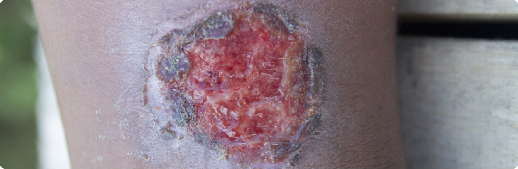 Ulcus cruris - Thrombose