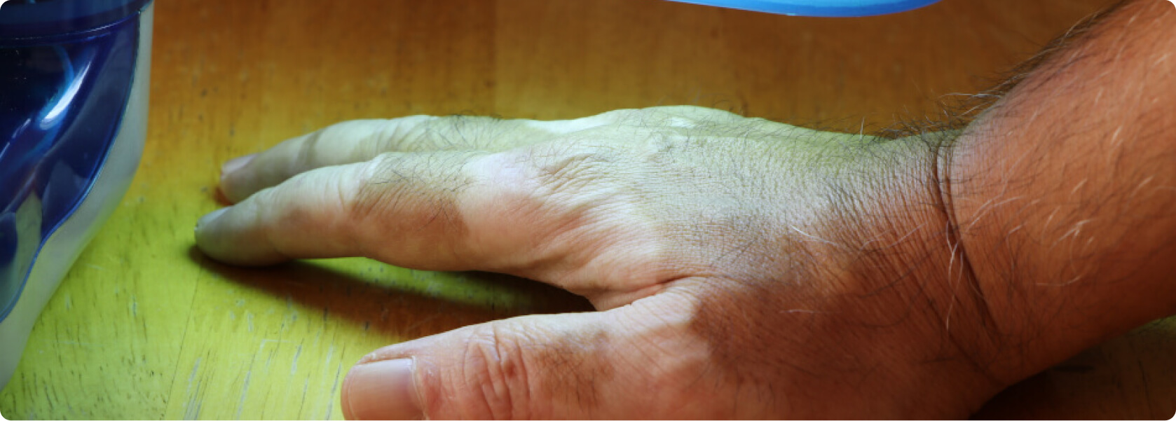 Vitiligo (Weißfleckenkrankheit) - Welche Ursachen hat Vitiligo?