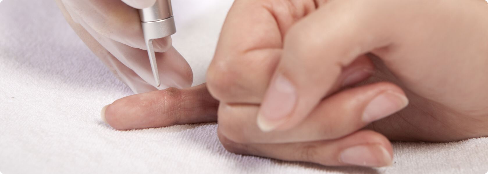 Warzen entfernen - mit einer Lasertherapie entfernen