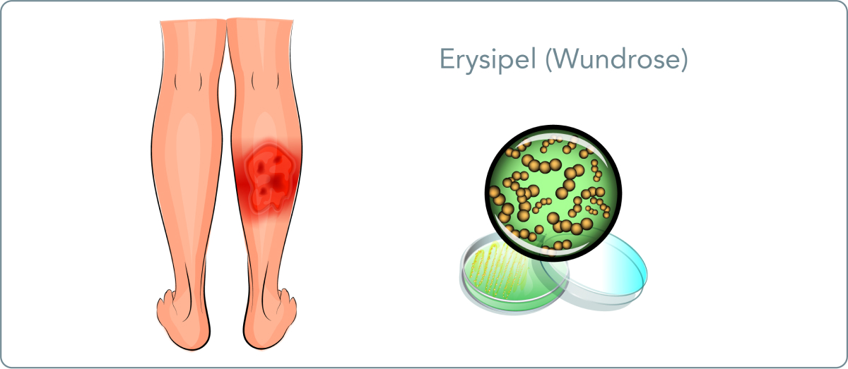 Erysipel (Wundrose) - Was versteht die Medizin unter einem Erysipel?