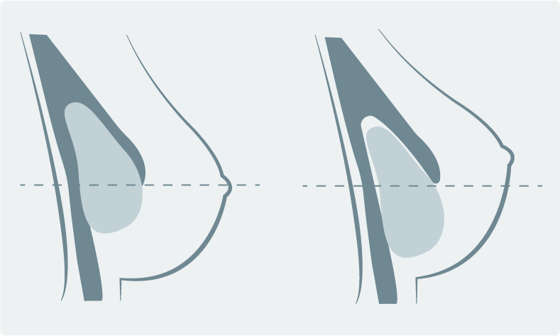 Brustrekonstruktion - Kann das Implantat abrutschen (Bottoming out)?