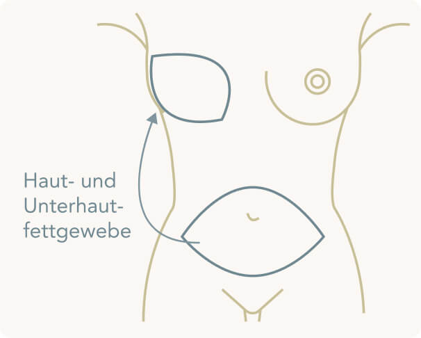 Brustrekonstruktion - DIEP Lappen Technik