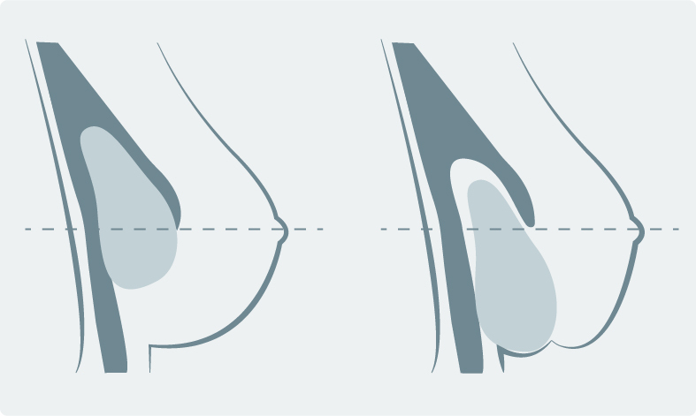 Brustrekonstruktion - Was ist unter einer Doppelbrust zu verstehen (Double Bubble)?