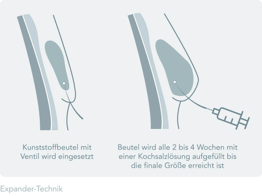Brustrekonstruktion - Die Expander Technik