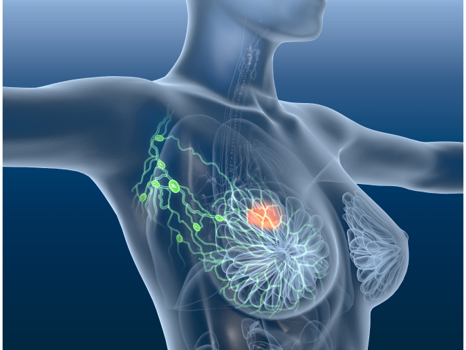 Brustrekonstruktion - Kann es zu vergrößerten Lymphknoten kommen?
