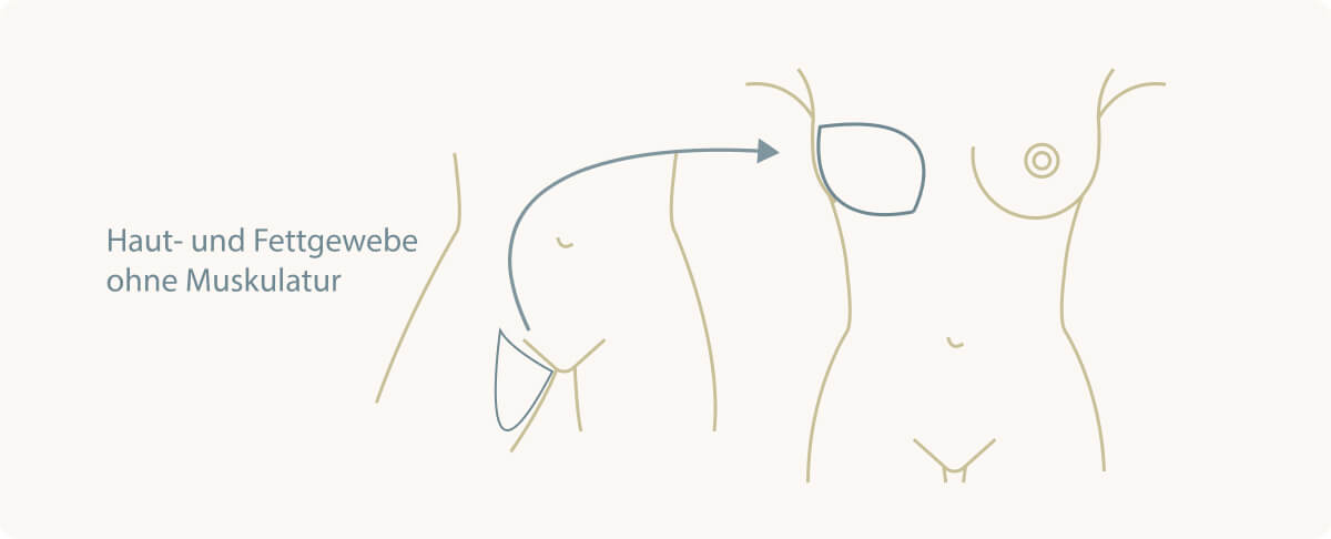 Brustrekonstruktion - PAP-FLAP