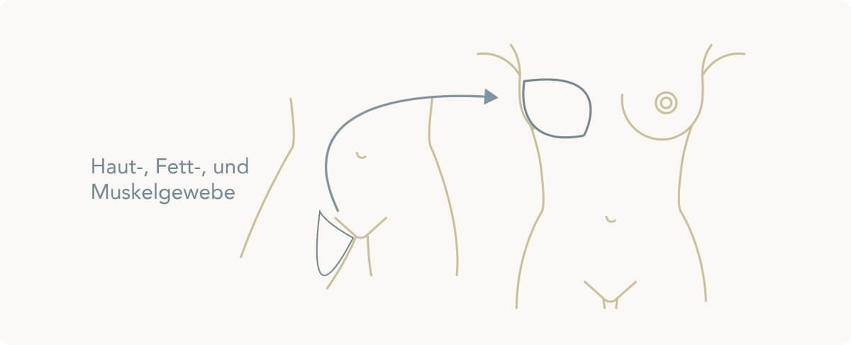 Brustrekonstruktion - TUG/TMG/Gracilis-Lappen