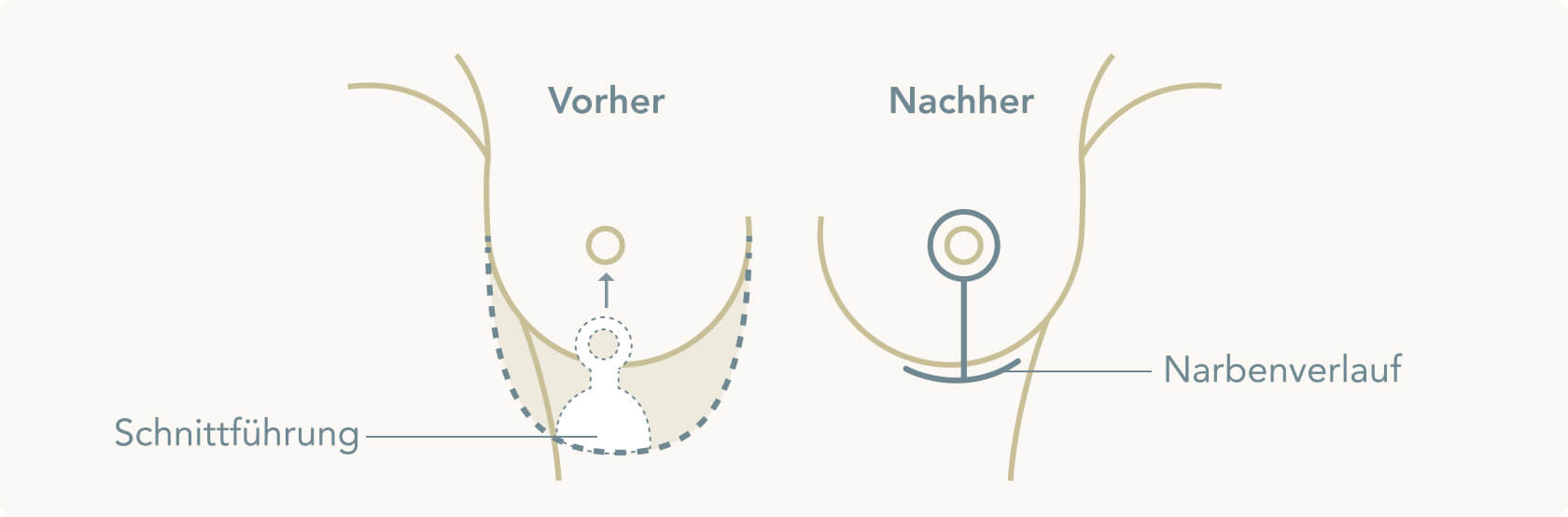 Möglichkeiten einer Bruststraffung