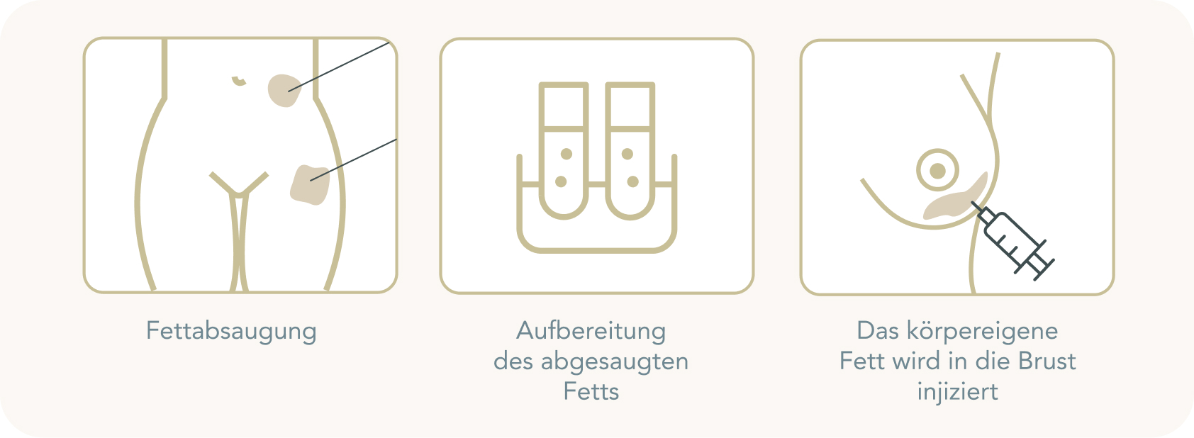 Brustvergrößerung mit Eigenfett - Wie unterscheidet sich eine Brustvergrößerung mit Eigenfett von einer mit Implantaten?